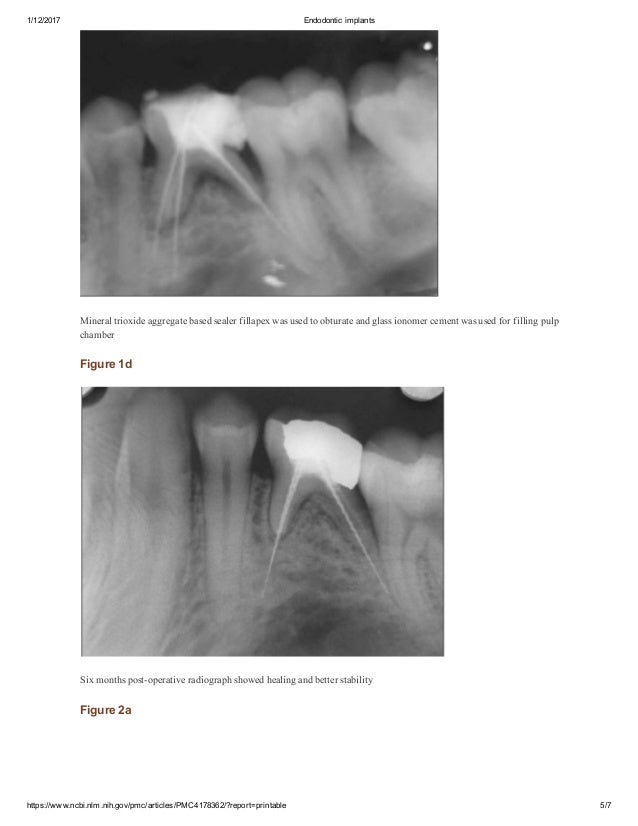 Endodontic implants