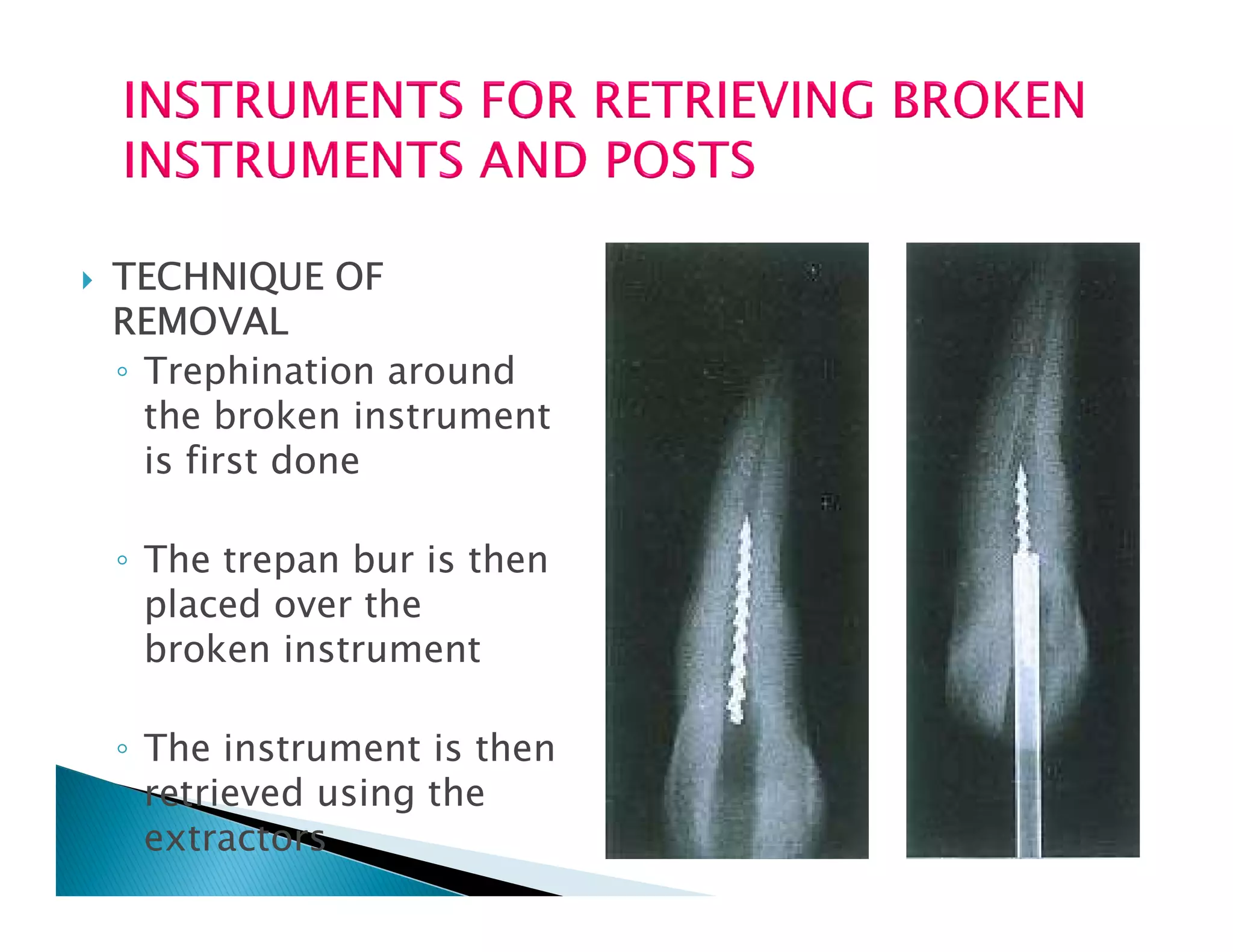 Endodontic instruments