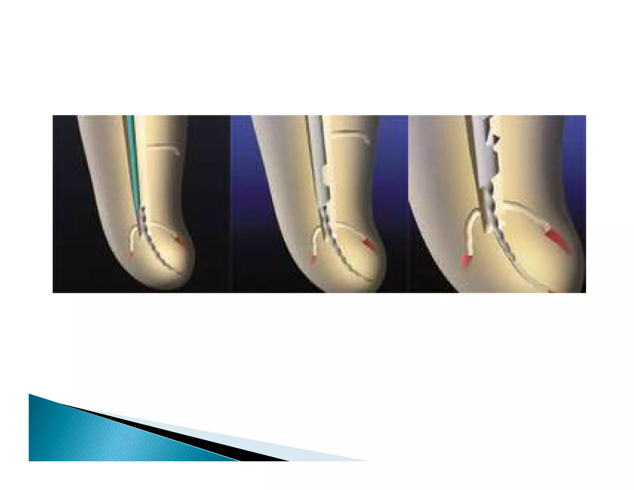 Endodontic instruments