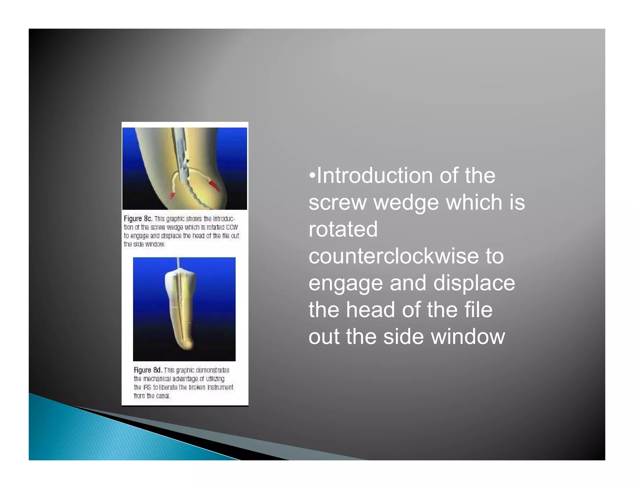 Endodontic instruments