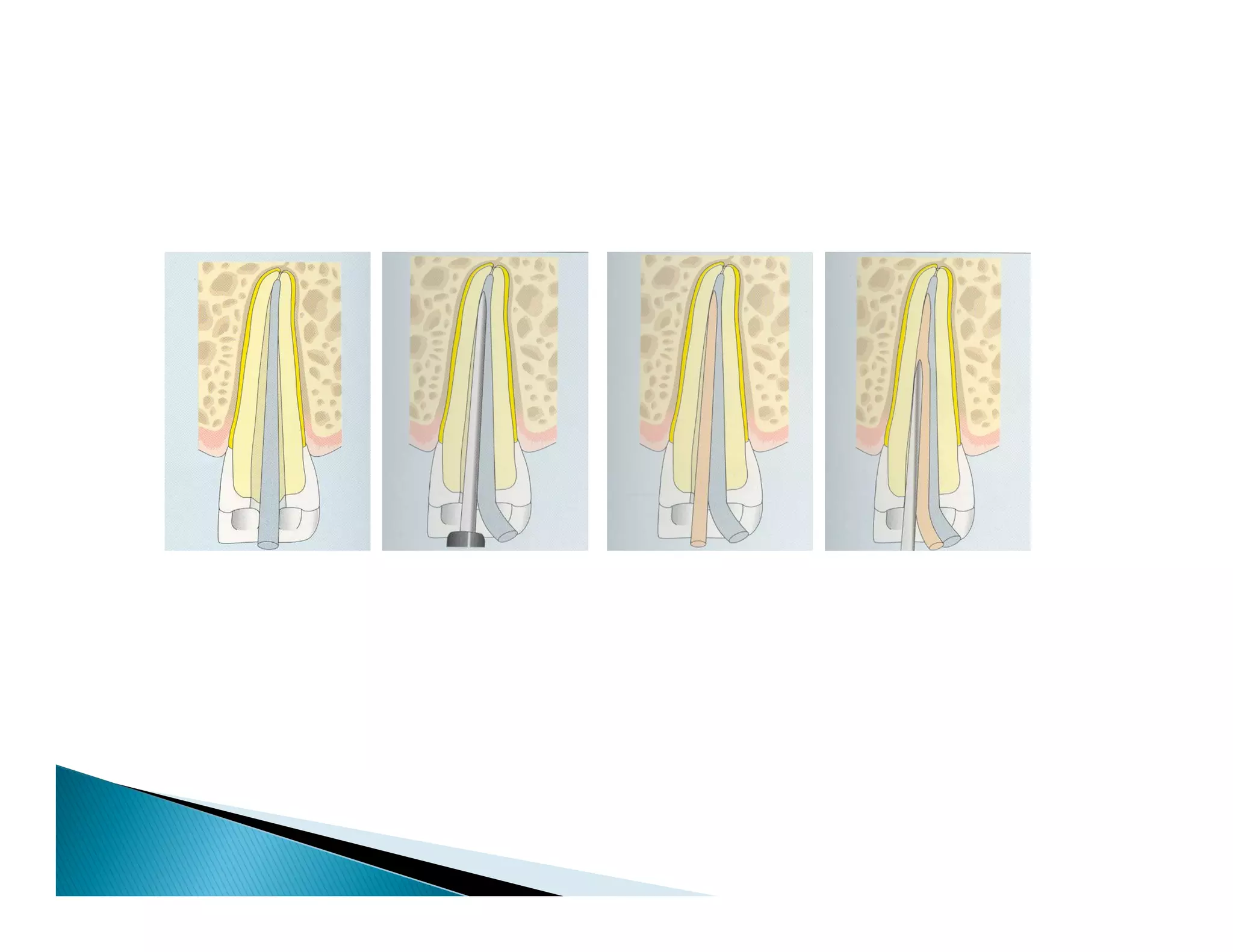 Endodontic instruments