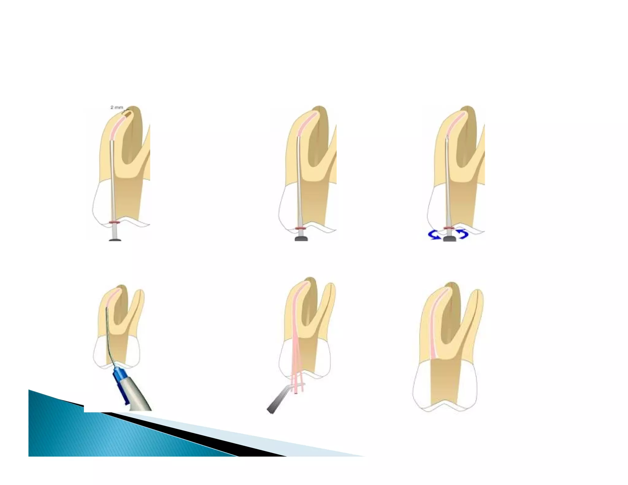 Endodontic instruments