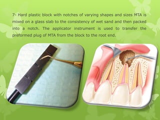 7- Hard plastic block with notches of varying shapes and sizes MTA is
mixed on a glass slab to the consistency of wet sand and then packed
into a notch. The applicator instrument is used to transfer the
preformed plug of MTA from the block to the root end.
 