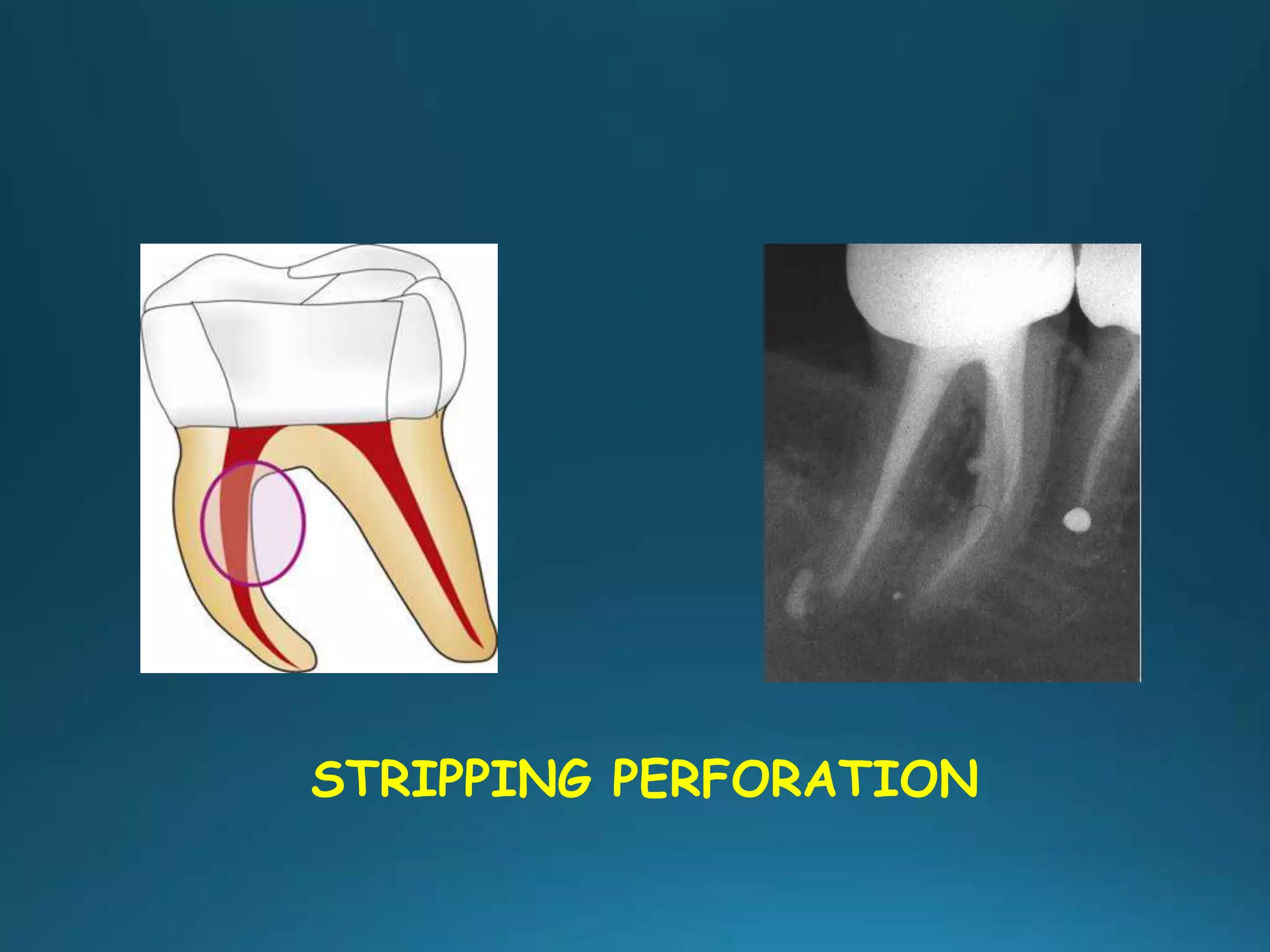 STRIPPING PERFORATION
 