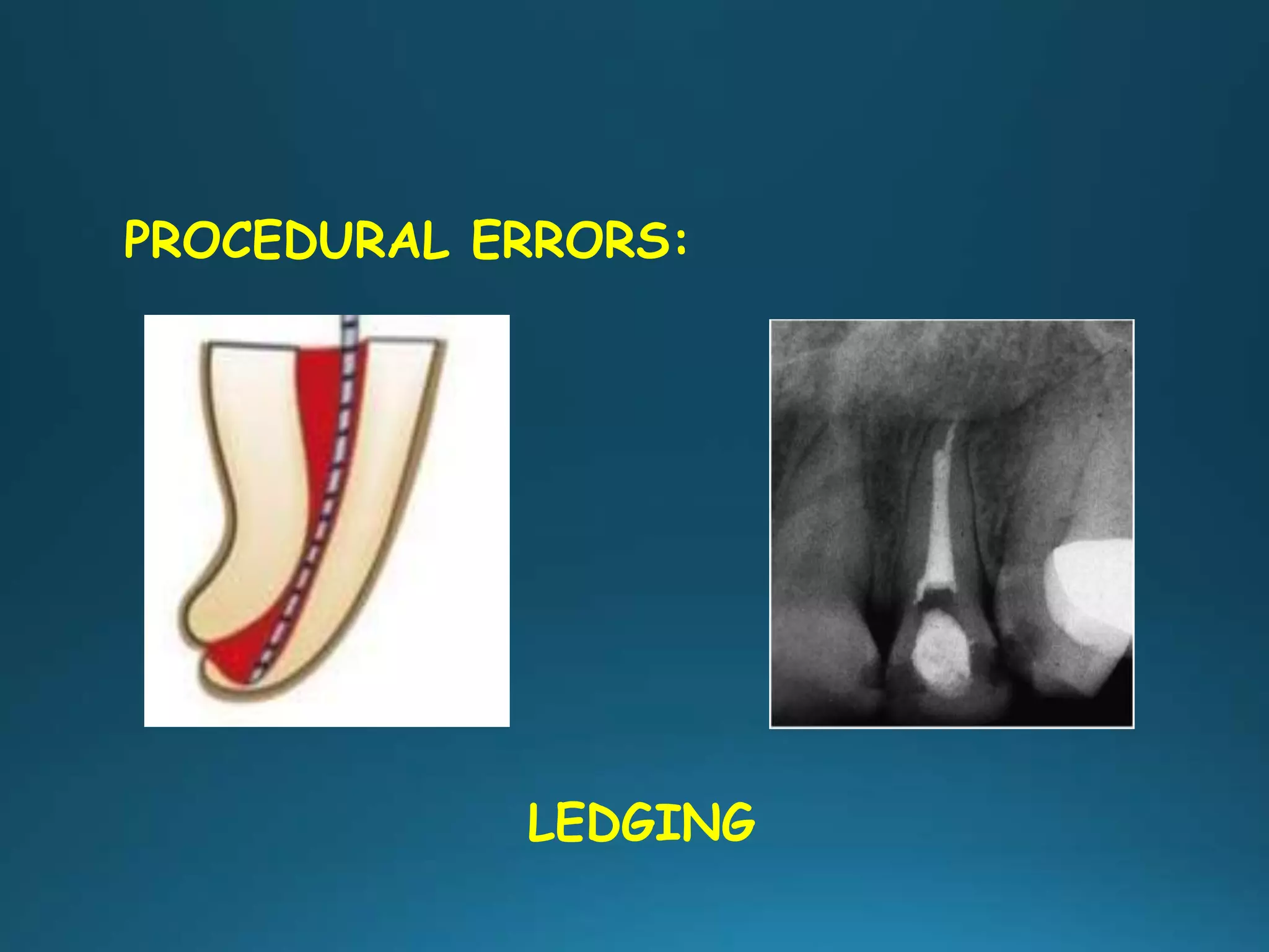 LEDGING
PROCEDURAL ERRORS:
 