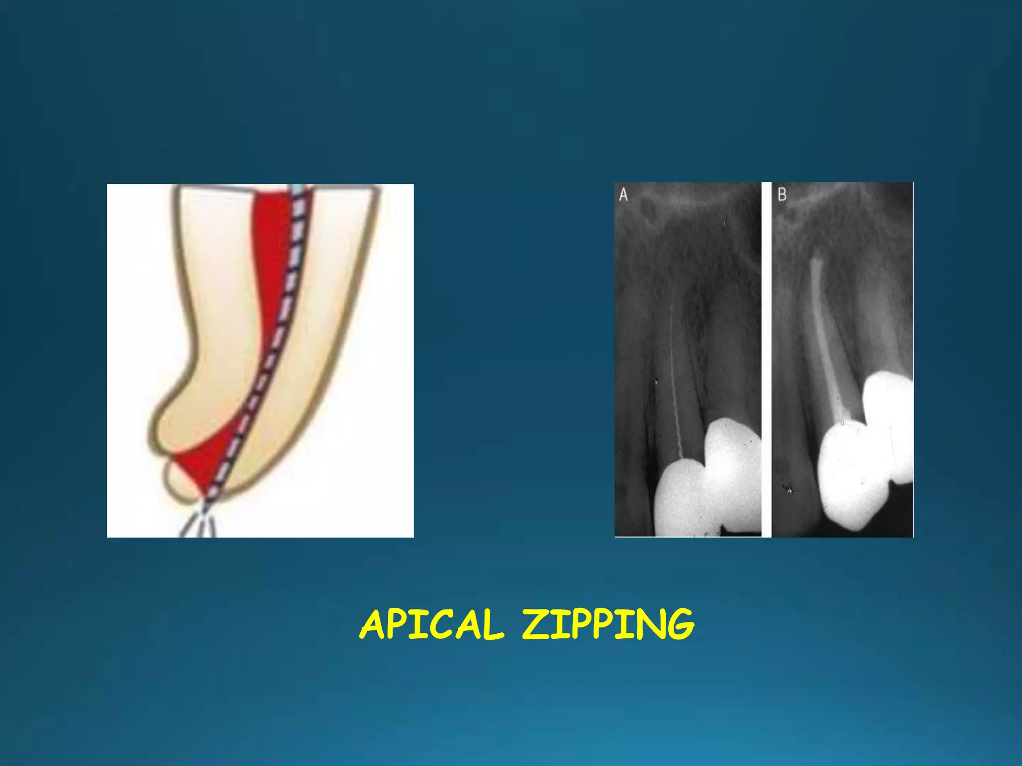 APICAL ZIPPING
 