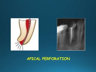 APICAL PERFORATION
 