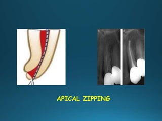 APICAL ZIPPING
 