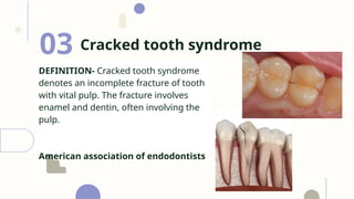 endodon management of cracked tooth.pptx
