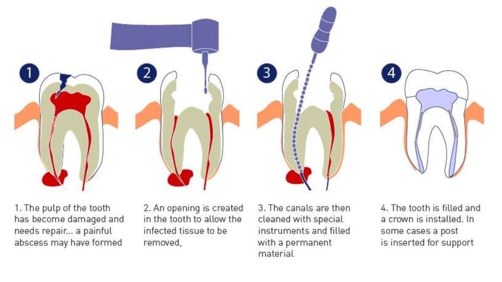 Endodontic materials