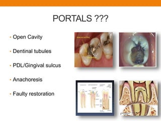 PORTALS ???
• Open Cavity
• Dentinal tubules
• PDL/Gingival sulcus
• Anachoresis
• Faulty restoration
 