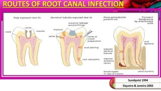 ROUTES OF ROOT CANAL INFECTION
Sundqvist 1994
Siqueira & Janeiro 2002
 