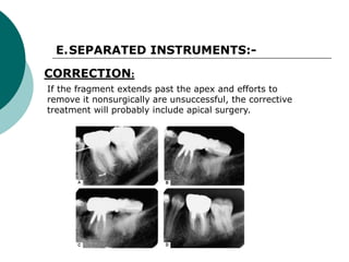 Separated Instrument ENDODONTIC MISHAPS.ppt