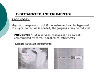 Separated Instrument ENDODONTIC MISHAPS.ppt