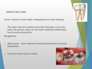 Infraction Tooth ENDODONTIC MISHAPS .AND RE-TREATMENTpptx | PPTX