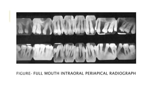 FIGURE- FULL MOUTH INTRAORAL PERIAPICAL RADIOGRAPH
 