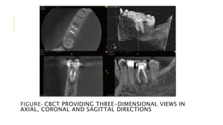 FIGURE- CBCT PROVIDING THREE-DIMENSIONAL VIEWS IN
AXIAL, CORONAL AND SAGITTAL DIRECTIONS
 