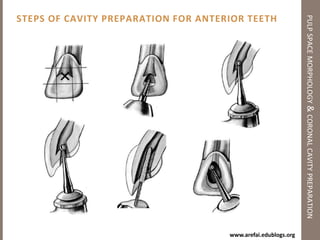 Causes (3 causes)pulp space morphology & coronal cavity preparation