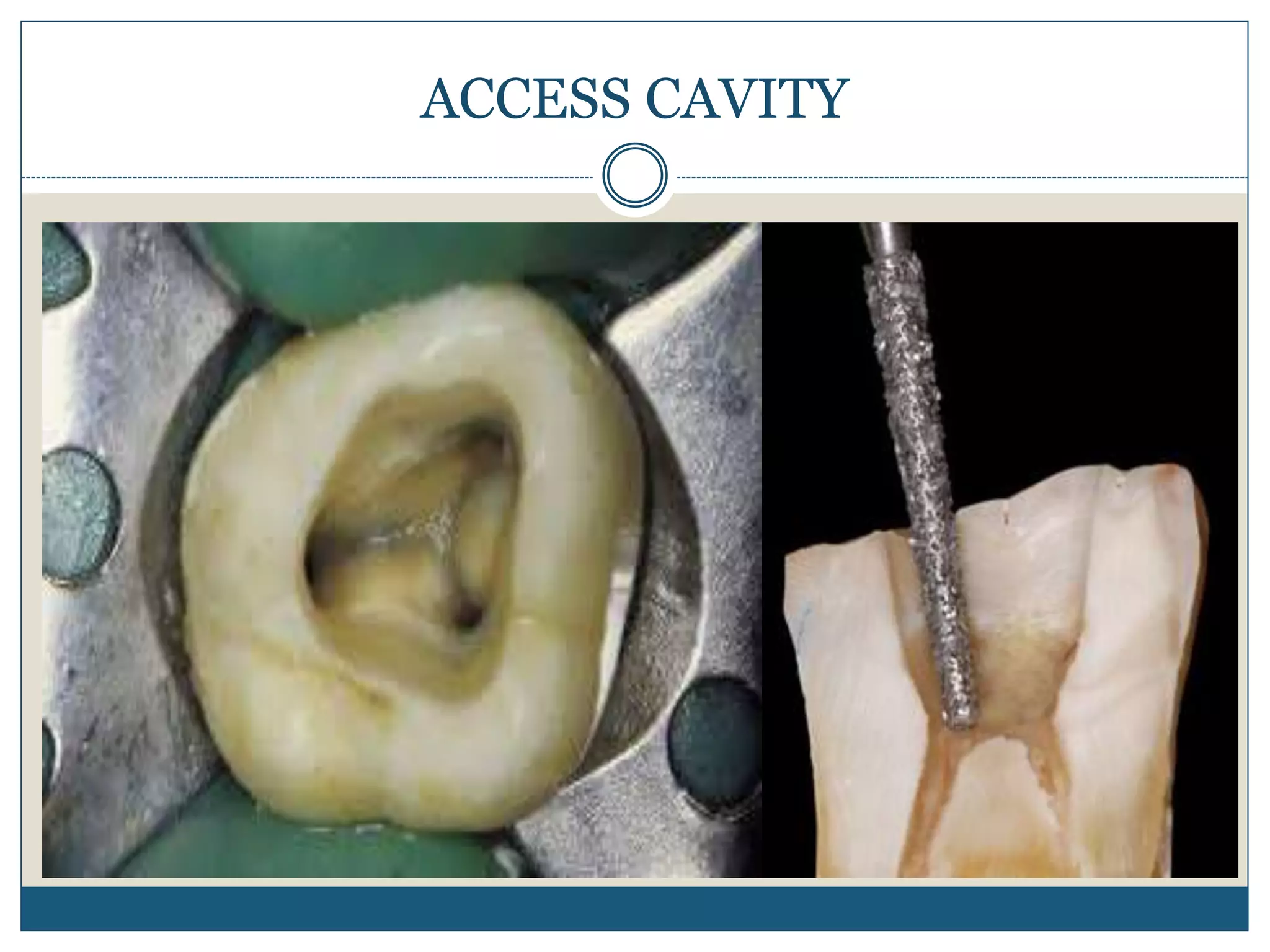 ACCESS CAVITY
 