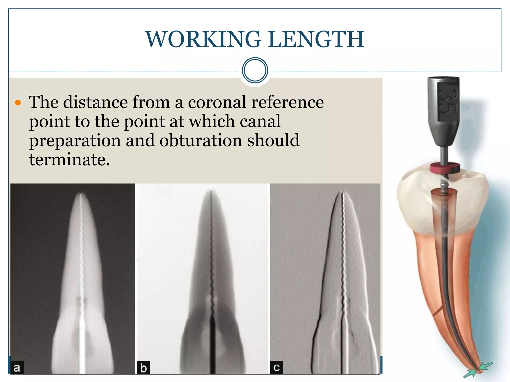 WORKING LENGTH
 The distance from a coronal reference
point to the point at which canal
preparation and obturation should
terminate.
 