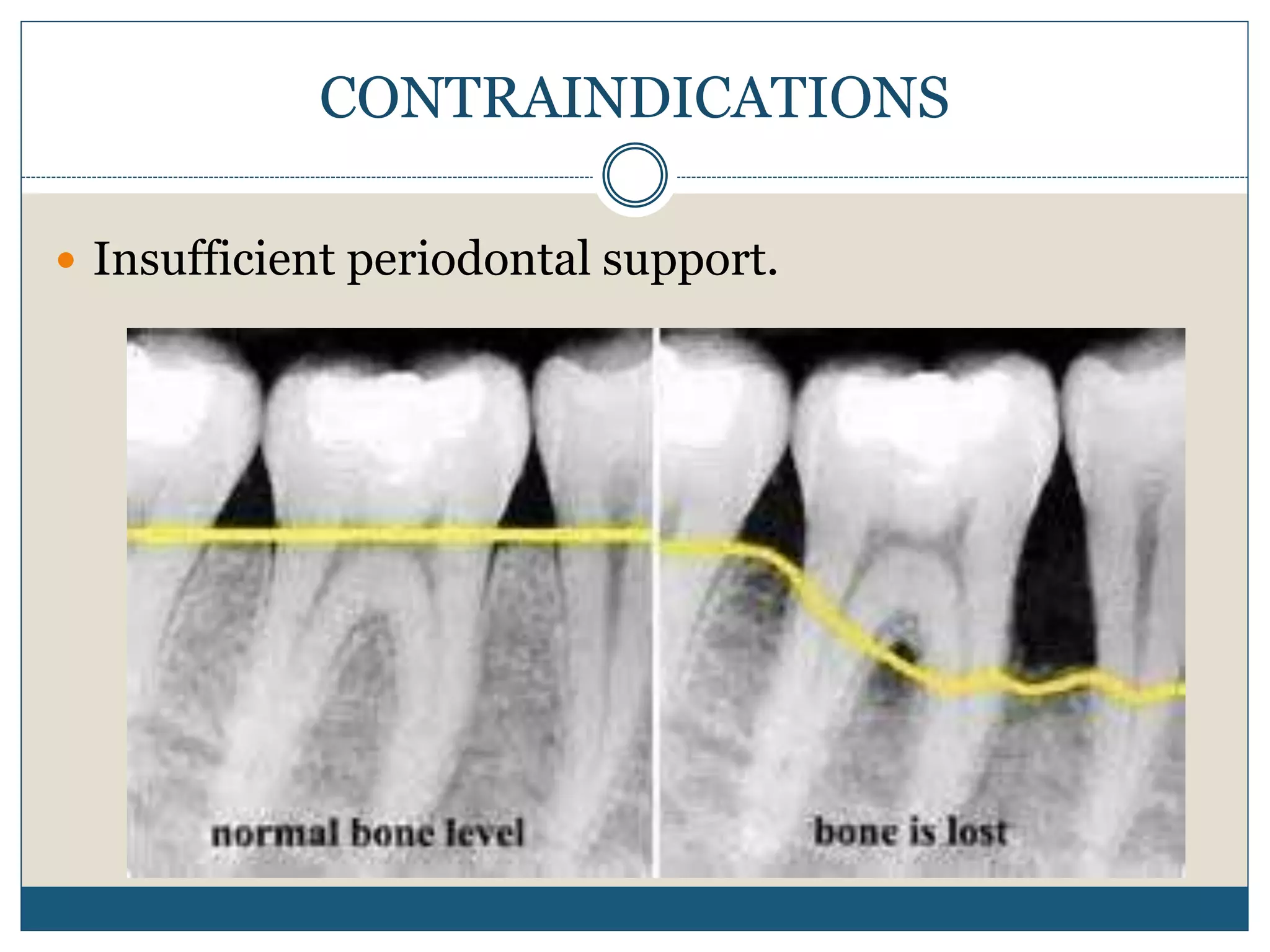  Insufficient periodontal support.
CONTRAINDICATIONS
 