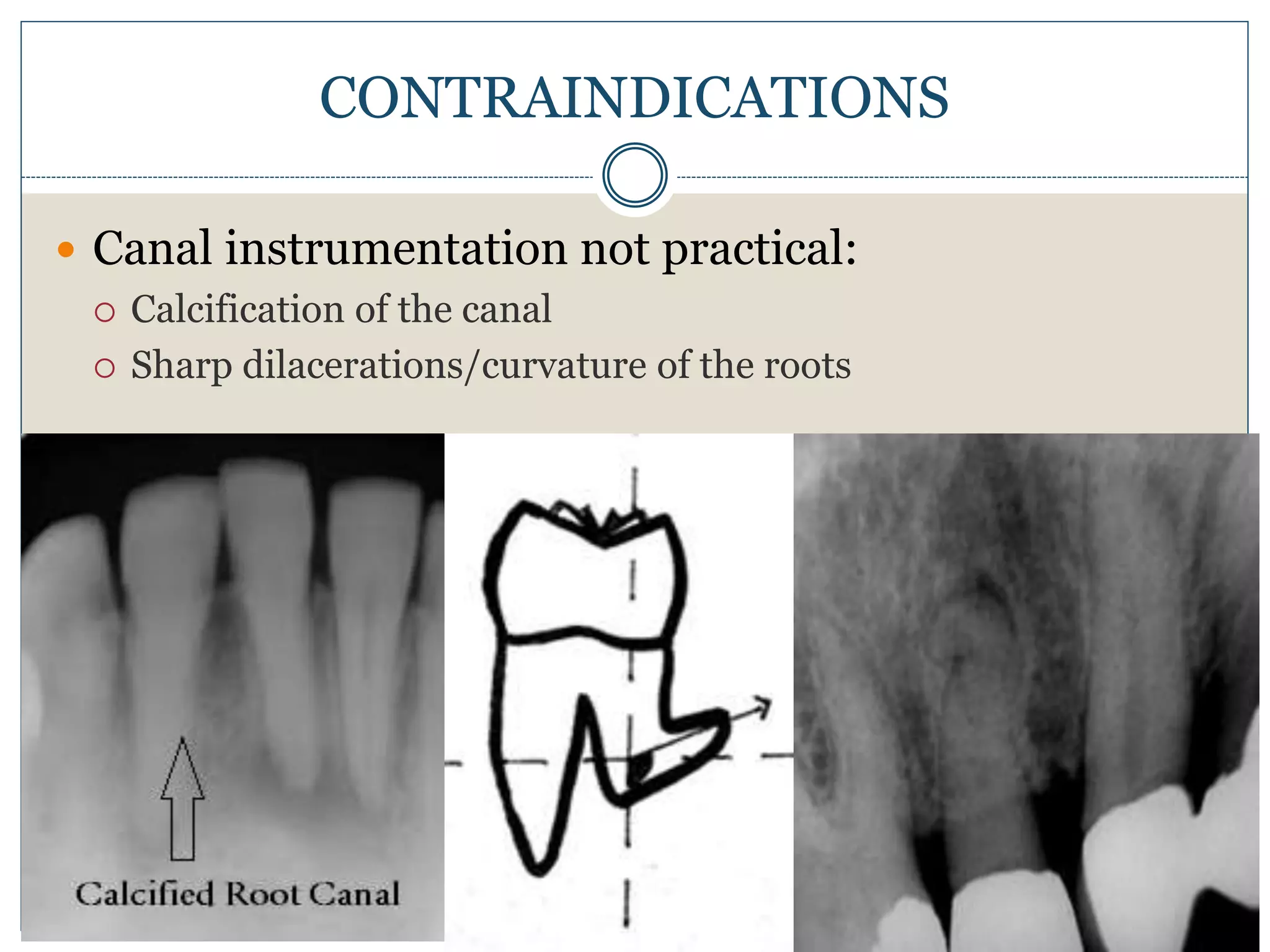  Canal instrumentation not practical:
 Calcification of the canal
 Sharp dilacerations/curvature of the roots
CONTRAINDICATIONS
 
