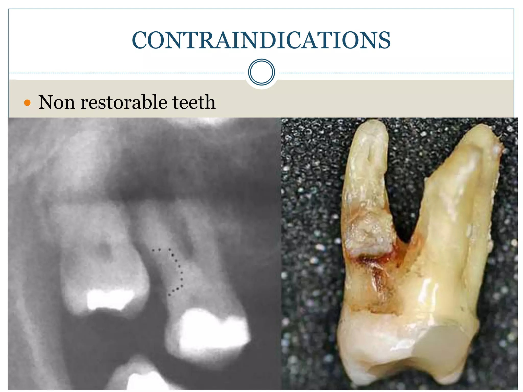  Non restorable teeth
CONTRAINDICATIONS
 