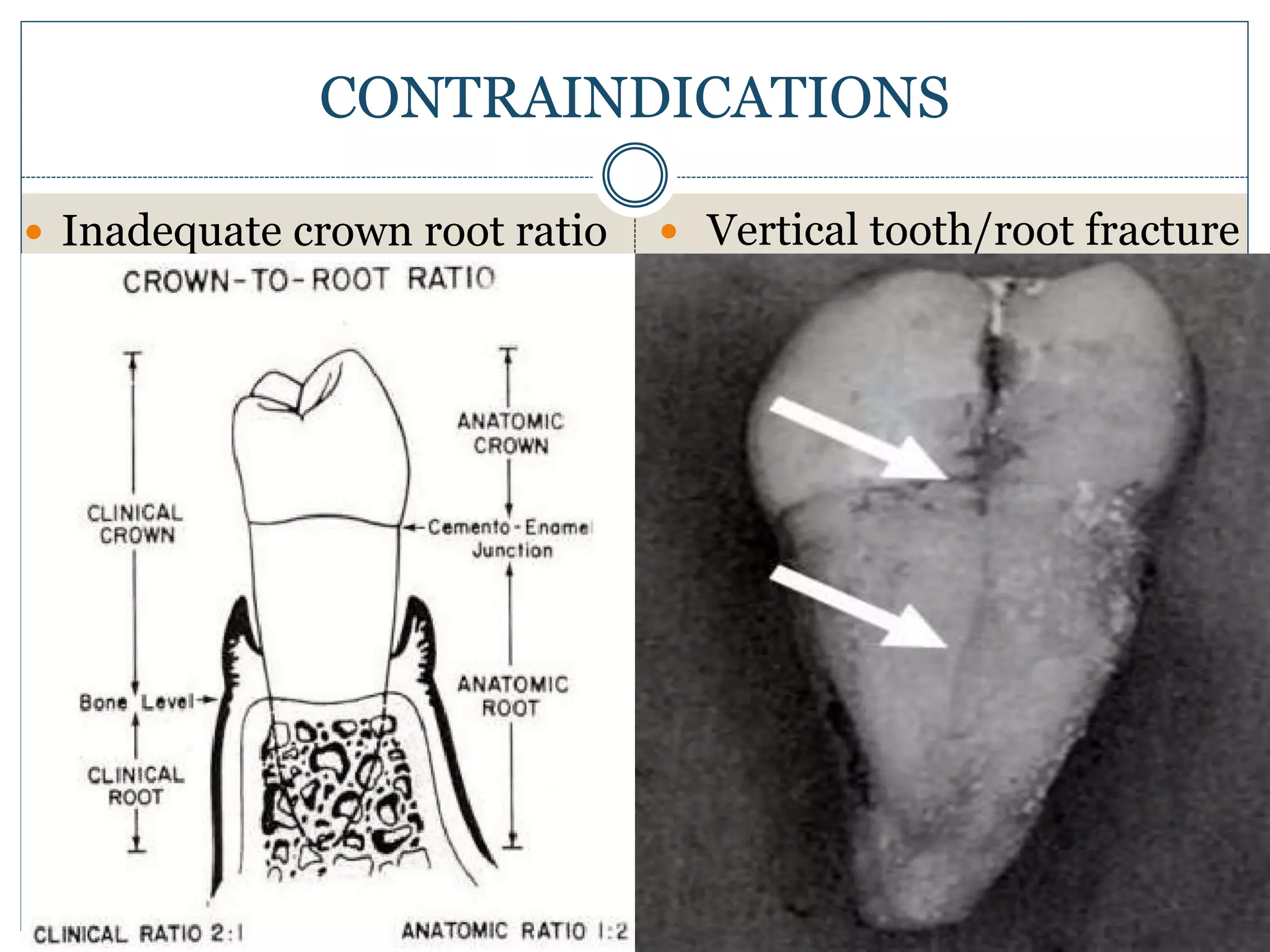 CONTRAINDICATIONS
 Inadequate crown root ratio  Vertical tooth/root fracture
 