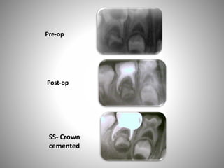 Pre-op
Post-op
SS- Crown
cemented
 