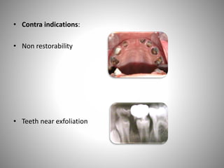 • Contra indications:
• Non restorability
• Teeth near exfoliation
 