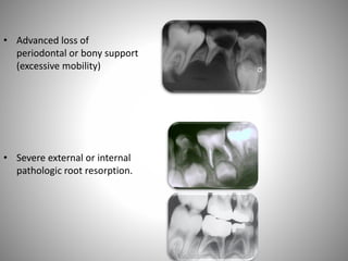 • Advanced loss of
periodontal or bony support
(excessive mobility)
• Severe external or internal
pathologic root resorption.
 