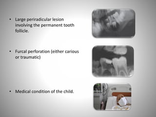 • Large periradicular lesion
involving the permanent tooth
follicle.
• Furcal perforation (either carious
or traumatic)
• Medical condition of the child.
 
