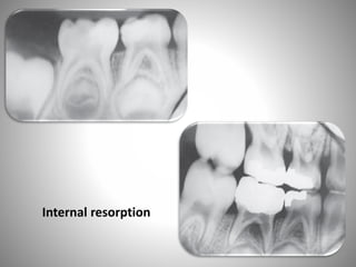Internal resorption
 