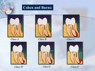 Cohen and Burns:
Class A Class B Class C
Class D Class E Class F
 