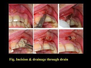 Fig. Incision & drainage through drain
 