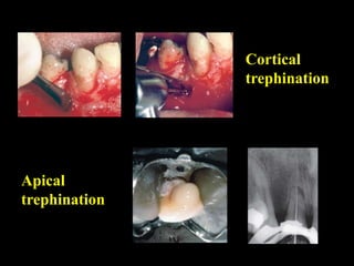 Cortical
trephination
Apical
trephination
 