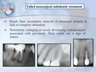 Failed nonsurgical endodontic treatment
 Result from incomplete removal of intracanal irritants &
lack of complete obturation.
 Persistently enlarging or newly developing radiolucencies
associated with previously filled canals are a sign of
failure.
 