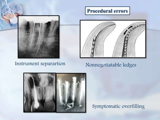 Procedural errors
Instrument separartion Nonnegotiatable ledges
Symptomatic overfilling
 