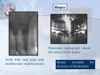 Biopsy
Teeth with vital pulp with
mulitilocular radiolucencies
Panoramic radiograph shows
the extent of this lesion
Biospy revealed the
presence of keratocytes
 