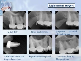 Replacement surgery
Initial RCT Sinus tract persists Symptoms persisted
after retreatment
Atraumatic extraction
& apical resection
Replantation completed 3 months follow up
No symptoms
 