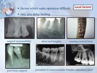 Local factors factors which make operation difficult
 may also delay healing
surgical inaccessibility short root lengths missing cortical bone
poor bone support proximity to neurovascular bundles, maxillary sinus
 
