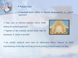  Palatal root
 reached from either a buccal (transantral) or palatal
approach
 Take care of anterior palatine artery while
taking the palatal approach
 ligation of the external carotid artery may be
necessary, if artery is severed
 An acrylic surgical stent may be fabricated before surgery to assist
repositioning of the flap and help prevent pooling of blood under the flap.
 