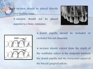  incision should be placed directly
over healthy bone.
 incision should not be placed
superior to a bony eminence.
 dental papilla should be included or
excluded but not dissected.
 incision should extend from the depth of
the vestibular sulcus to the midpoint between
the dental papilla and the horizontal aspect of
the buccal gingival sulcus.
 