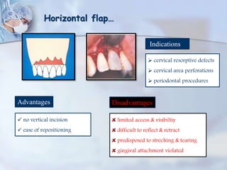 Horizontal flap…
Indications
 cervical resorptive defects
 cervical area perforations
 periodontal procedures
Advantages
 no vertical incision
 ease of repositioning
Disadvantages
limited access & visibiltiy
difficult to reflect & retract
predisposed to streching & tearing
gingival attachment violated
 