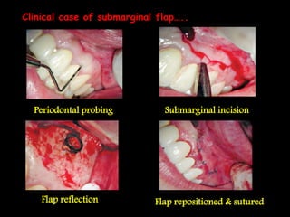 Clinical case of submarginal flap…..
Periodontal probing Submarginal incision
Flap reflection Flap repositioned & sutured
 