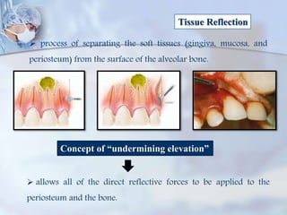 Tissue Reflection
 process of separating the soft tissues (gingiva, mucosa, and
periosteum) from the surface of the alveolar bone.
Concept of “undermining elevation”
 allows all of the direct reflective forces to be applied to the
periosteum and the bone.
 