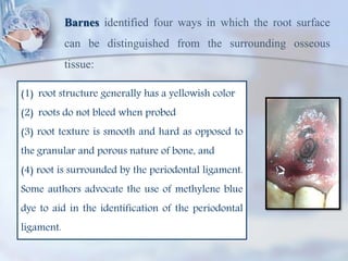 Barnes identified four ways in which the root surface
can be distinguished from the surrounding osseous
tissue:
(1) root structure generally has a yellowish color
(2) roots do not bleed when probed
(3) root texture is smooth and hard as opposed to
the granular and porous nature of bone, and
(4) root is surrounded by the periodontal ligament.
Some authors advocate the use of methylene blue
dye to aid in the identification of the periodontal
ligament.
 