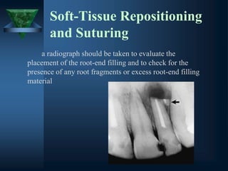 Soft-Tissue Repositioning
and Suturing
a radiograph should be taken to evaluate the
placement of the root-end filling and to check for the
presence of any root fragments or excess root-end filling
material
 