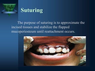 Suturing
The purpose of suturing is to approximate the
incised tissues and stabilize the flapped
mucoperiosteum until reattachment occurs.
 