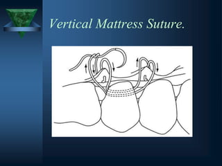 Vertical Mattress Suture.
 